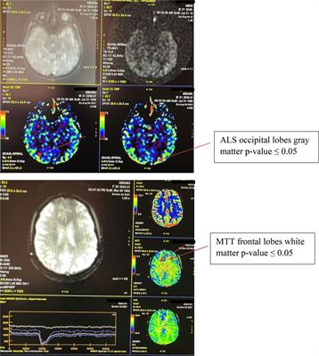 Interhemispheric asymmetry of the brain in patients with type 1 diabetes mellitus and cognitive impairment